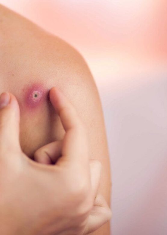 Epidermoid-Cyst-Shoulder-1024x682