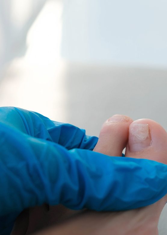 A close-up of a foot with a fungus on the nails is examined by a doctor in gloves.