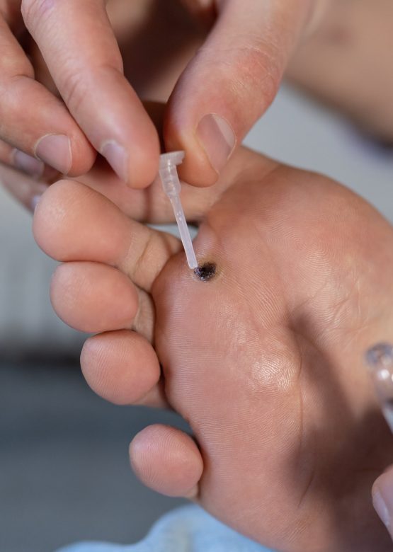 Alternative home treatment of verruca foot. Man applying liquid celandine extract on wart plantar.