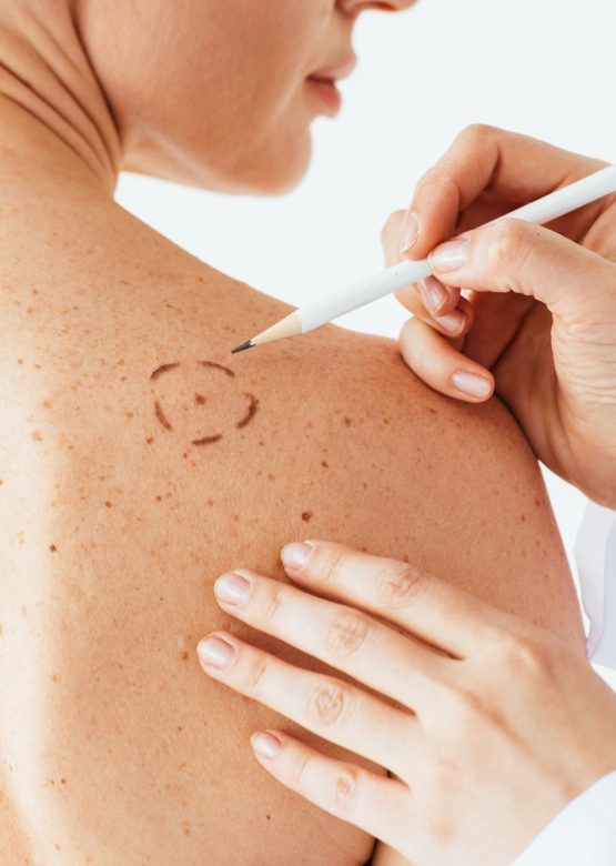 cropped view of dermatologist applying marks on skin of naked woman with melanoma isolated on white