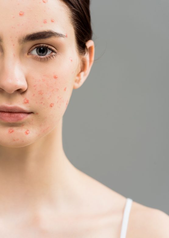 cropped view of young woman with acne looking at camera isolated on grey