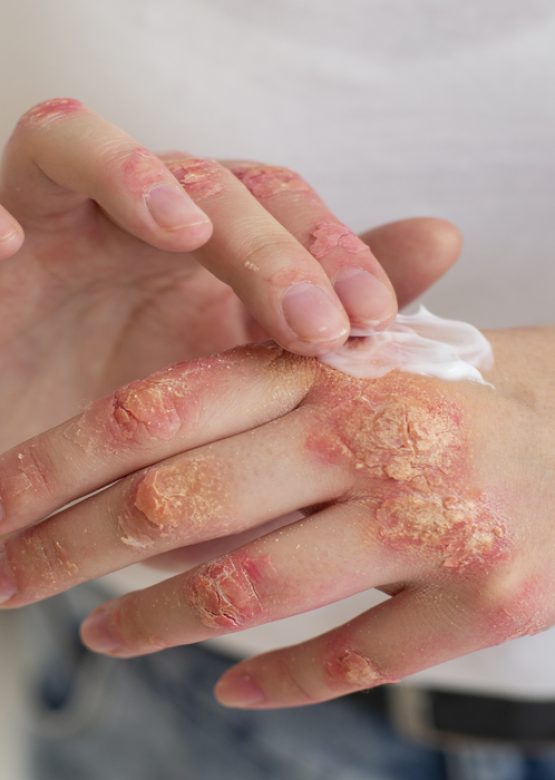 hands-patient-suffering-from-psoriasis