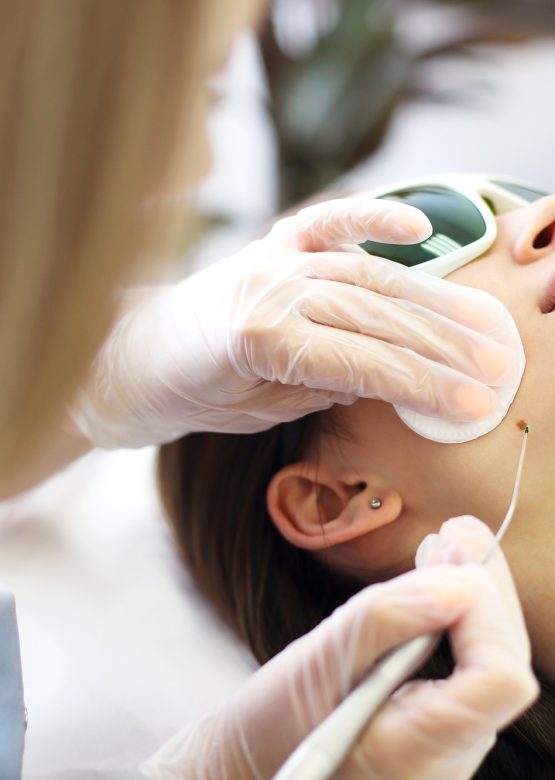 Laser mole removal on a woman's cheek in a beauty salon
