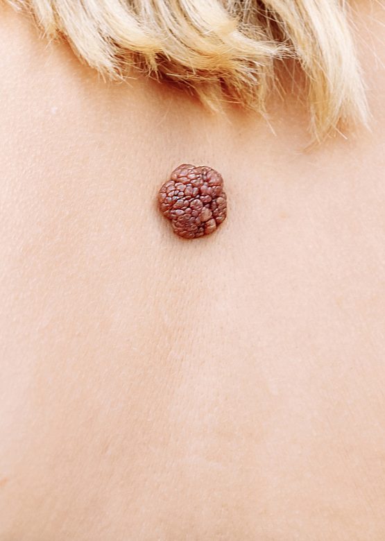 Wart. Mole. big wart on the skin. Skin diseases Malignant tumor. Dermatology. Oncology.