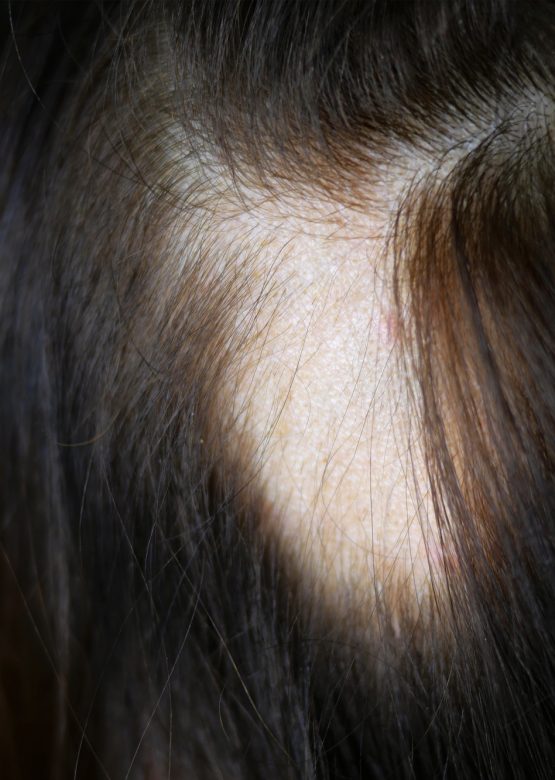 Woman hair loss. Head of woman on part of skin of which there is no hair.