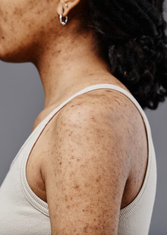 Woman with acne scars